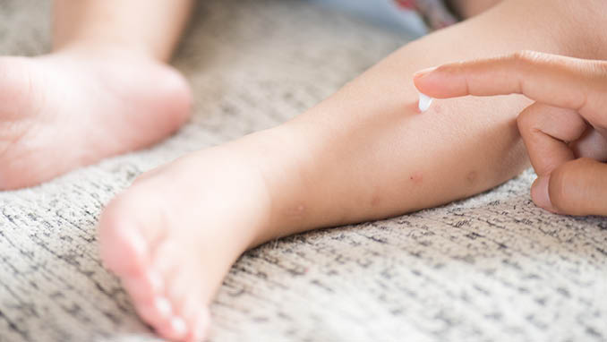 Mother applying cream on a girl's legs with red spot, blister  Medicine and health care concept 
