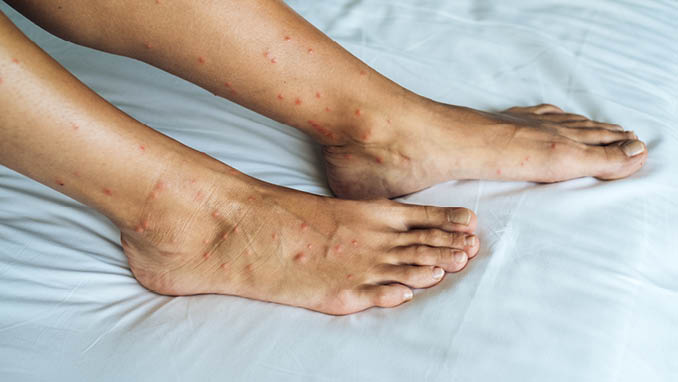 Female legs with many red spot and scar from sand fly bites in Thailand